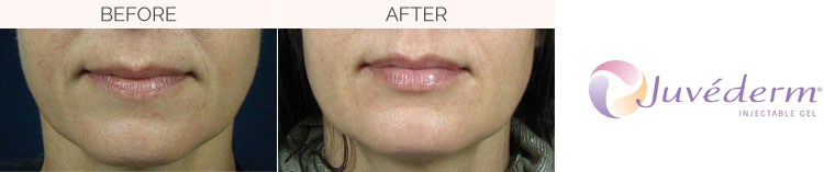 Before and After Juvederm