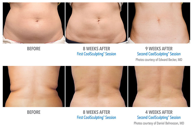 CoolSculpting